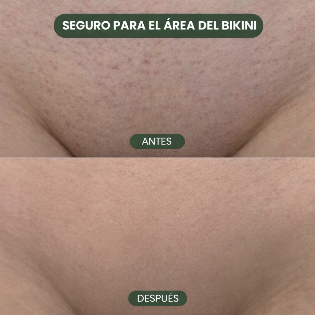 Aceite de Cyperus Rotundus 100% Natural — Compra 1 y Llévate 2 |