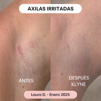 Depiladora LumiSkin  V 2.0 actualizada