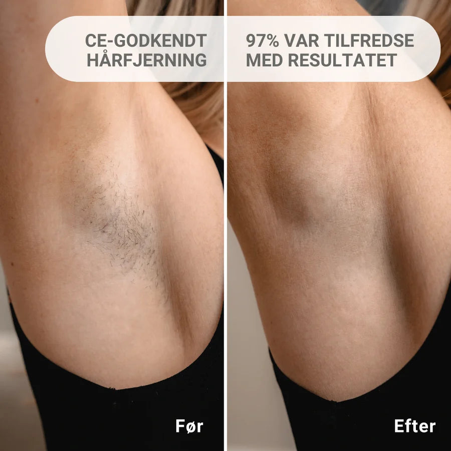LumiSkin- Depilación permanente IPL